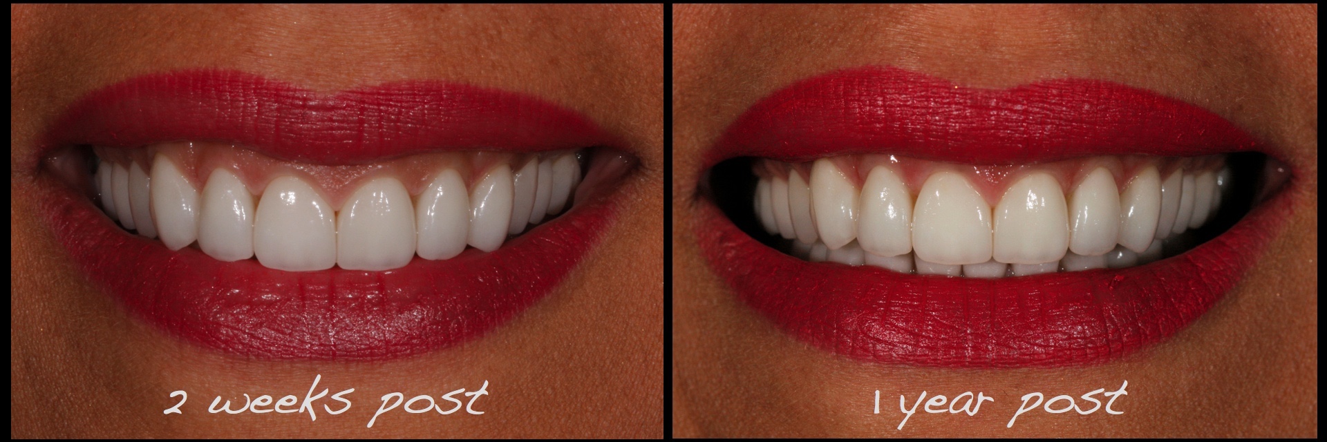 Full-Mouth-Reconstruction-Conservative-Alex-Sasia.026.jpg
